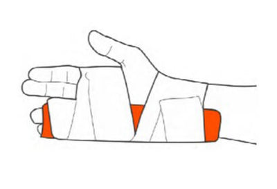 Using Sam Splints How to Use SAM Splints – SAM Medical Store